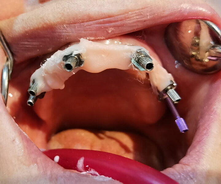 Dentalni implanti
