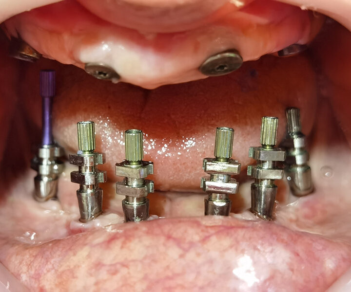 Dentalni implanti